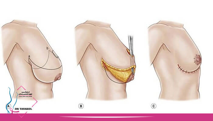 جراحی ماموپلاستی یا کوچک کردن سینه چگونه انجام می شود؟