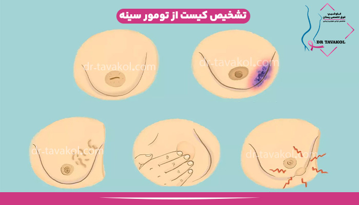 راه های تشخیص کیست و تومور سینه