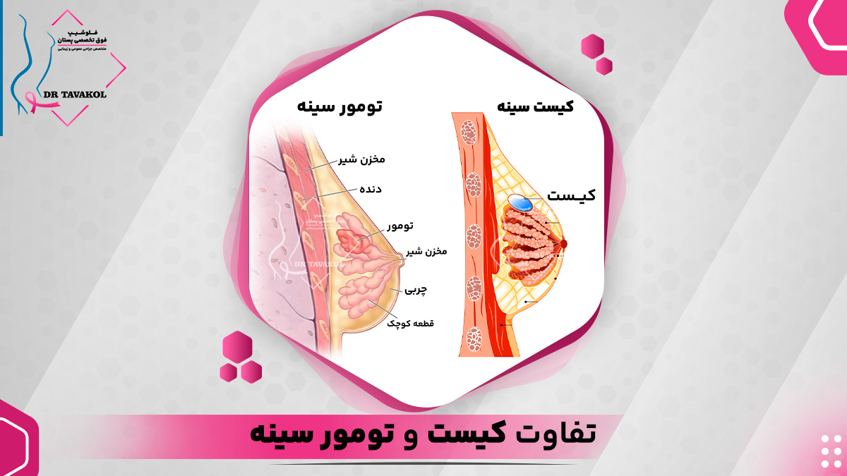 تفاوت کیست و تومور بدخیم سینه چیست