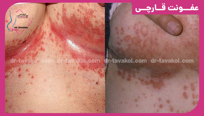 خارش سینه ناشی از عفونت قارچی